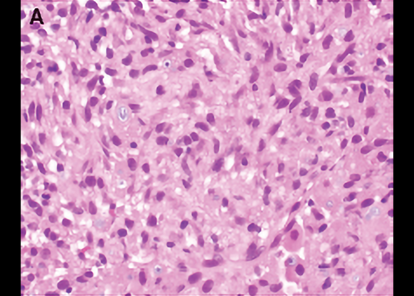 Fig 5. Transbronchial biopsy specimens demonstrated sheets of oval to spindled histiocytes some of which had light purple cytoplasmic inclusions