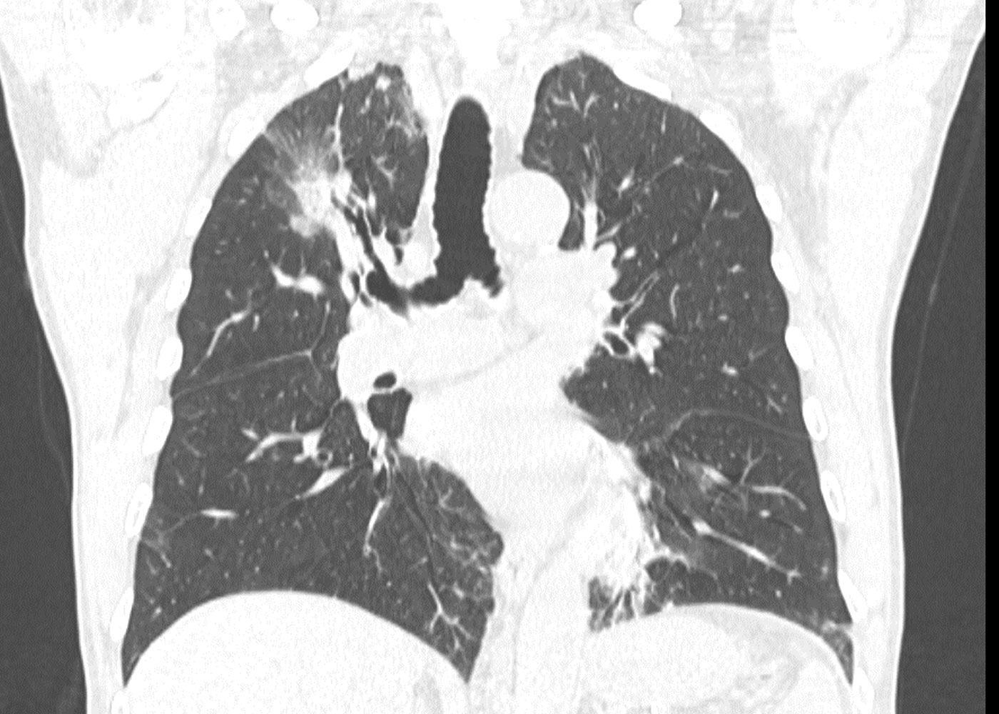 Fig 2.CT scan showing bilateral upper lobe ground glass lesions and RUL lesion solid component