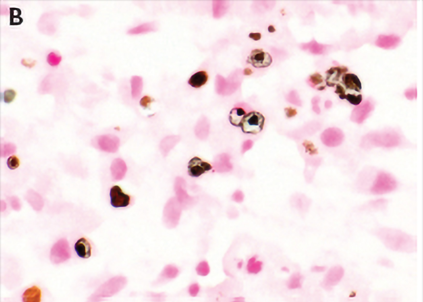Fig 6. Von Kossa staining highlights the diagnosis of malakoplakia