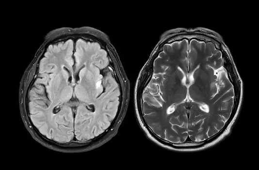認知症の45％は生活改善で予防可能
