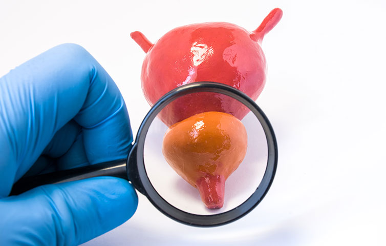 cancer de prostata blog 2