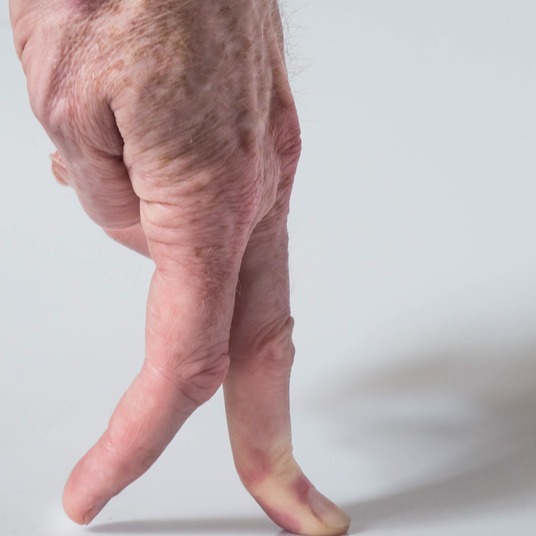 Gradual Prednisone Taper