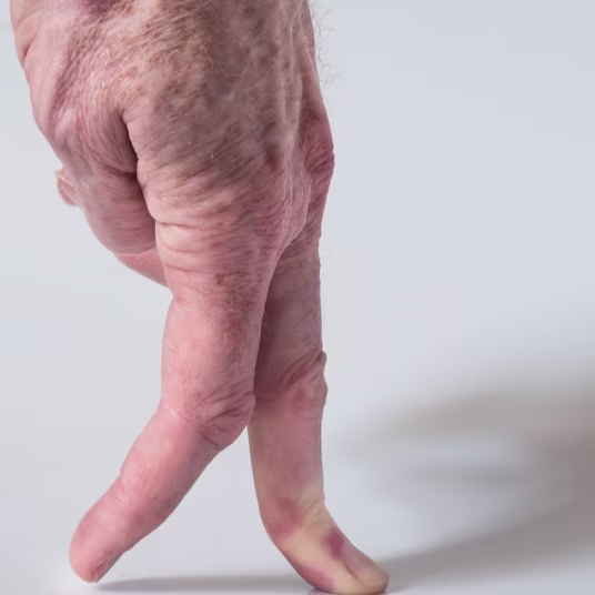 Gradual Prednisone Taper