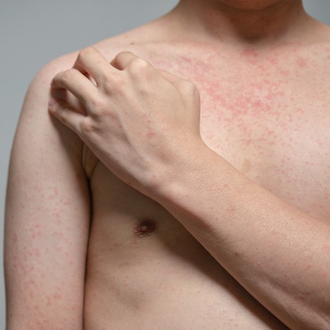 Itchy Skin Rash and Inflammation
