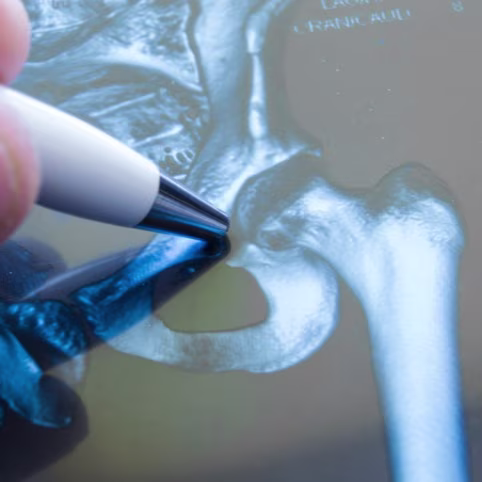 Hip Joint X-Ray Showing Fracture and Degenerative Changes