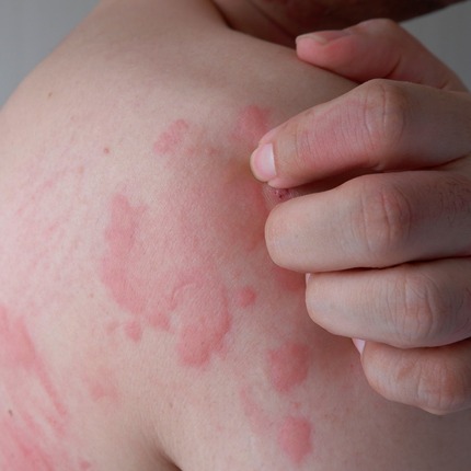 Skin Under Stress: The Visible Impact of Cholinergic Urticaria