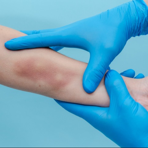 Evaluating Bruising During Apixaban Therapy