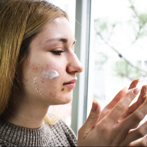 Young Adult women with acne applying skin lotion
