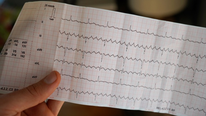 Hand holding a real electrocardiogram with atrial flutter