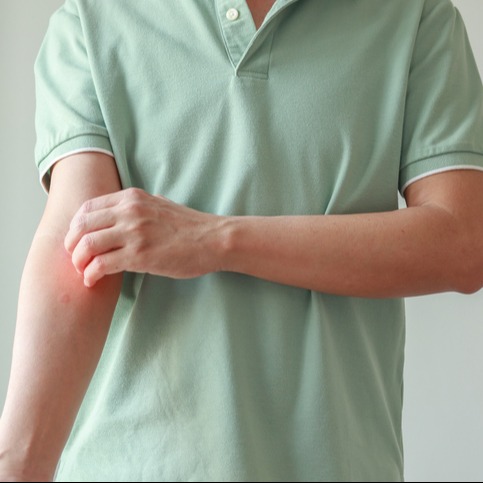 Managing Itchy Skin: Eczema, Dermatitis, and Allergic Reactions