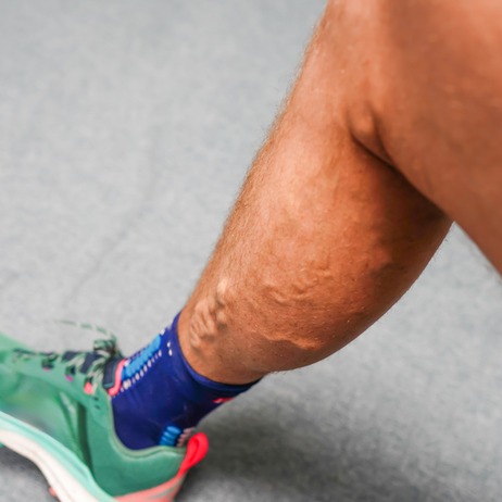 Varicose Veins and Leg Pain
