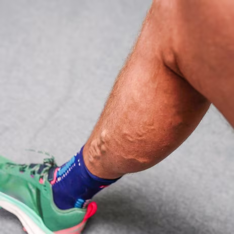 Varicose Veins and Leg Pain