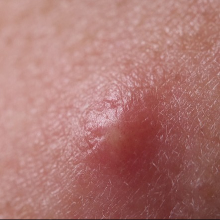 Pimple With Pus Under the Skin