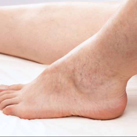 Capillary Telangiectasia