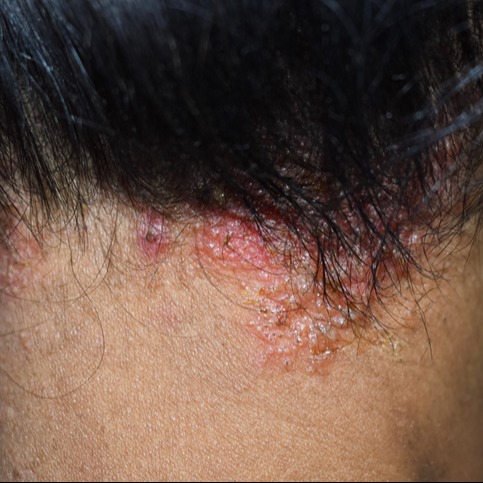 Seborrheic Dermatitis on Scalp