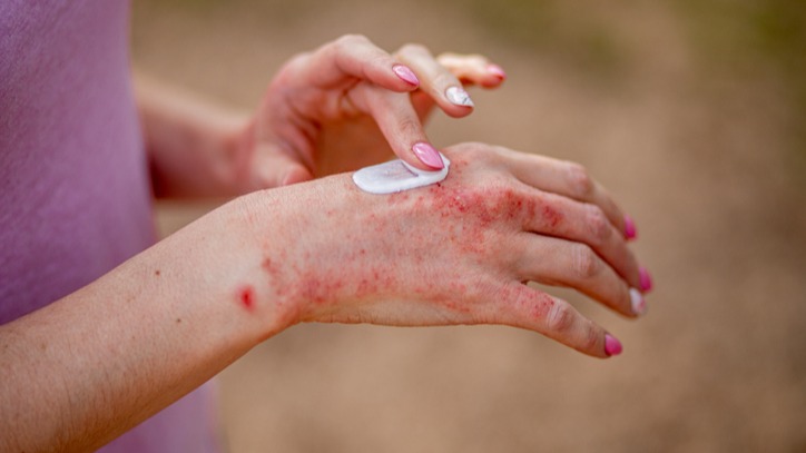 The woman applying the ointment , creams in the treatment of eczema, psoriasis and other skin diseases.