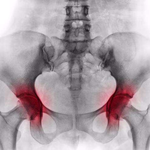 X-Ray View of Hip Arthritis: Degeneration in Both Hip Joints