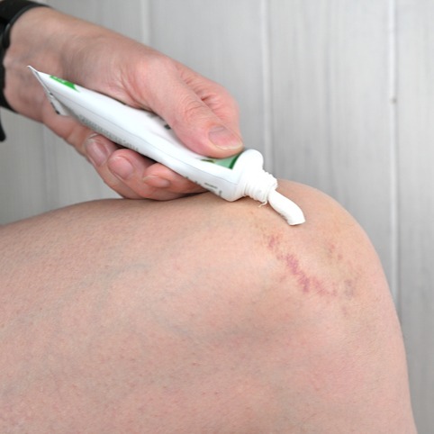 Applying Topical Anesthetic Cream to a Minor Burn