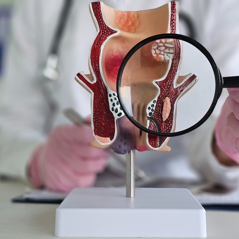 External Hemorrhoids (Rectum & Anal Canal)