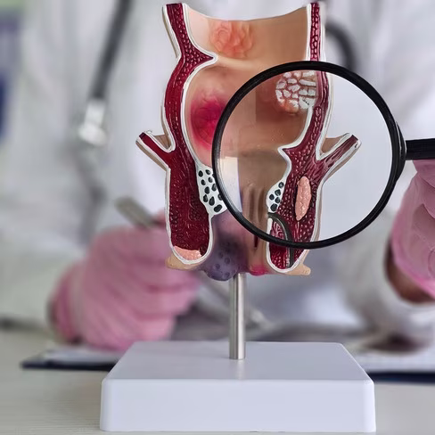 External Hemorrhoids (Rectum & Anal Canal)