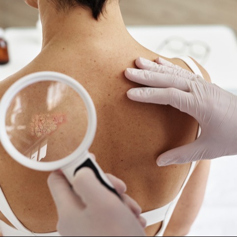 Trapezius back of a person showing skin with Psoriasis plaques