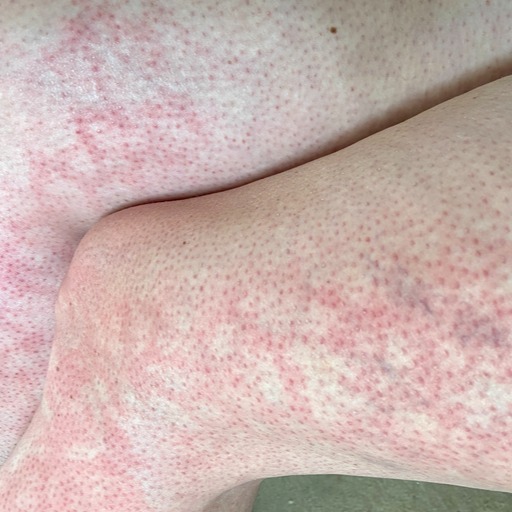 Heat-Related Skin Mottling