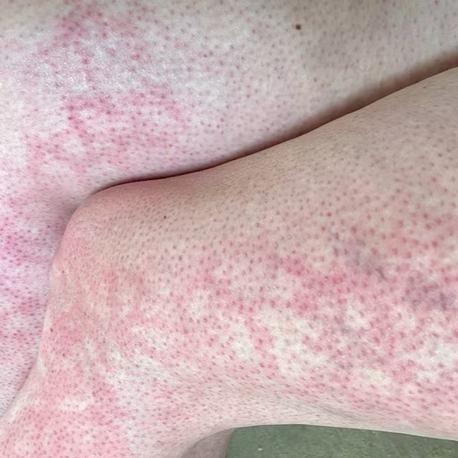 Heat-Related Skin Mottling