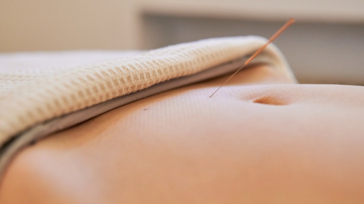 Close up of acupuncture Acupuncture in IBS Management