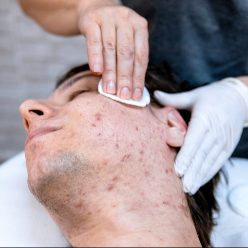 Face Pimples Skin cleaning at dermatologist