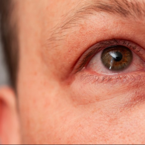 Dry Eye Inflammation in Sjögren’s Syndrome