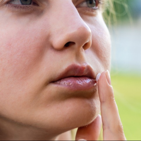 Herpes on the lips of young woman