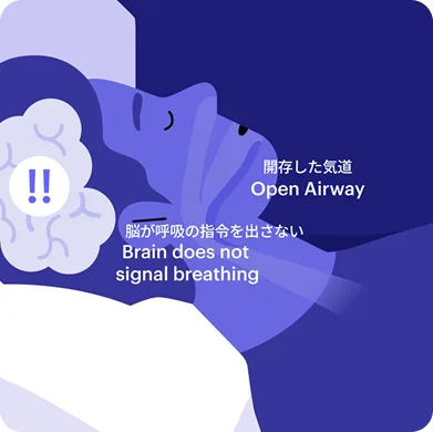Central Sleep Apnea Syndrome Image