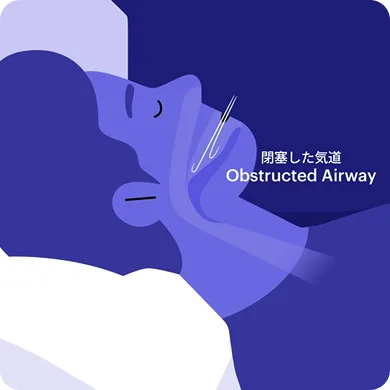 Obstructive Sleep Apnea Syndrome Image