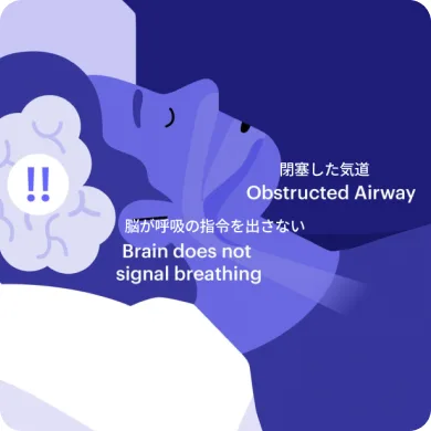 Complex Sleep Apnea Syndrome Image