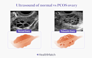 PCOS AntimoMariluz