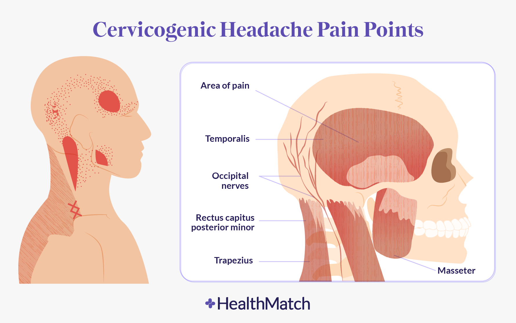 stiff-neck-or-headaches-try-this-quick-fix-dr-alan-mandell-dc