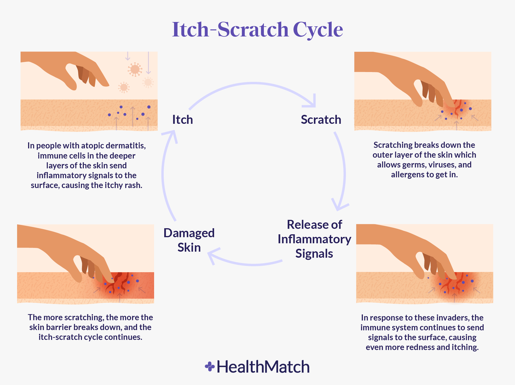 Healthmatch More Than Itchy Skin The Full Impact Of Living With Eczema 