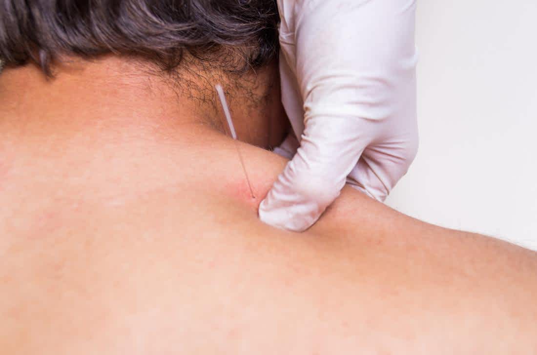 What is the difference between Acupuncture and IMS?