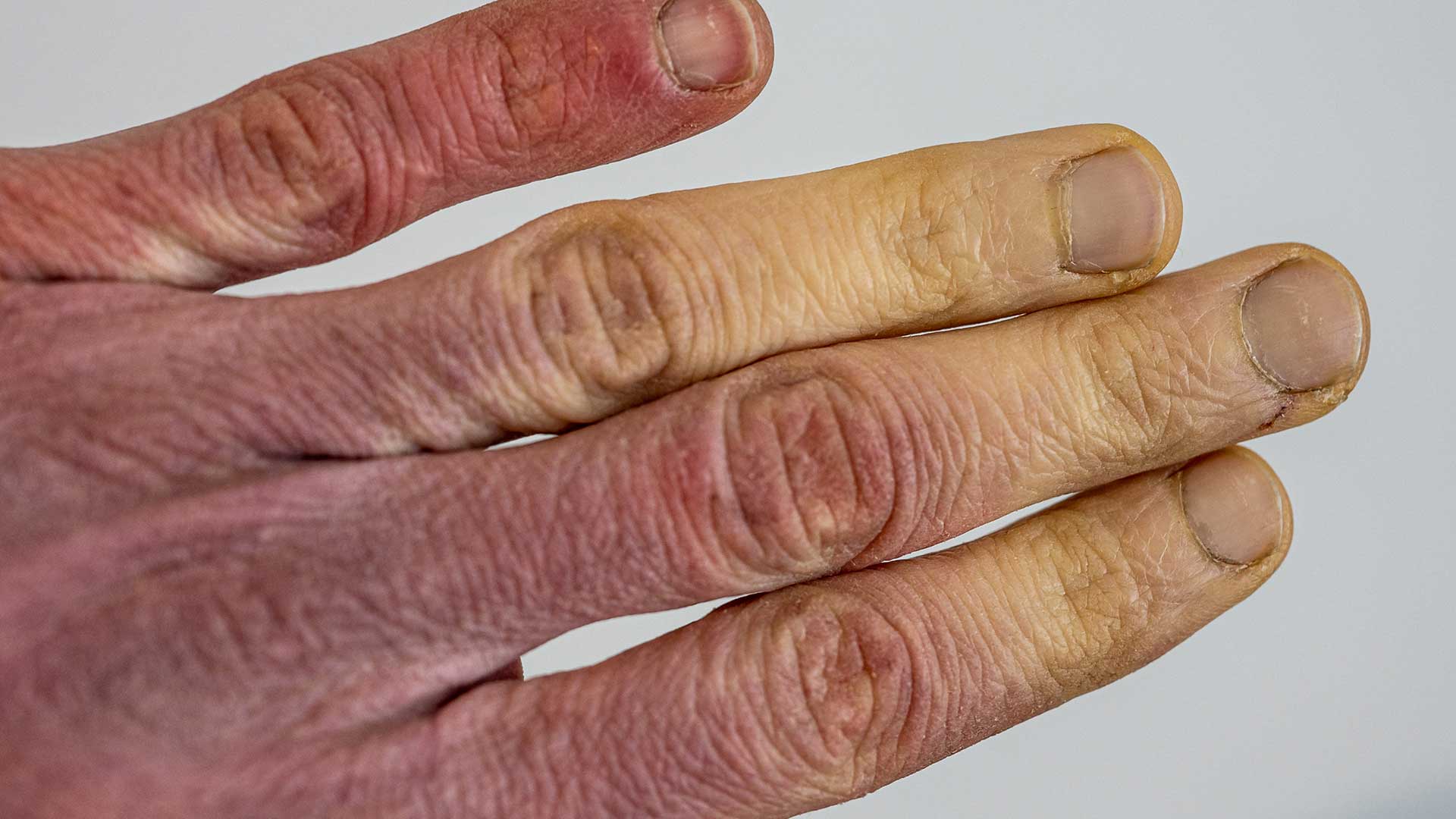 raynauds1FEATUREDIMAGE