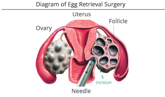The Steps And Decisions In The Ivf Process Fertilityiq
