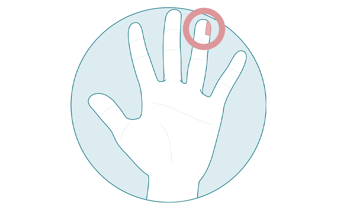 hand with left side of the top of the ring finger highlighted