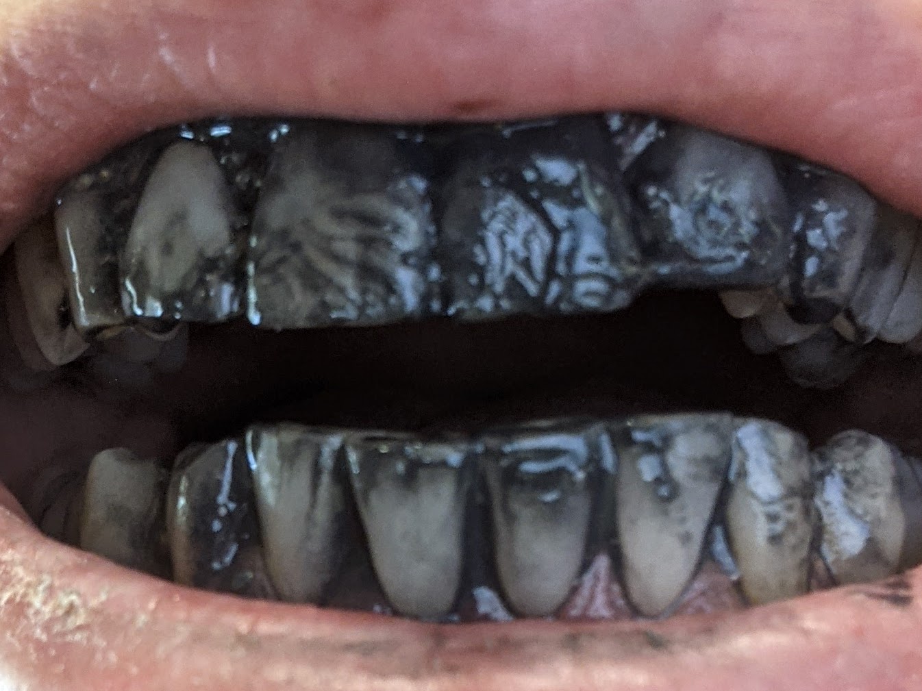 Photo of teeth with black charcoal toothpaste on them