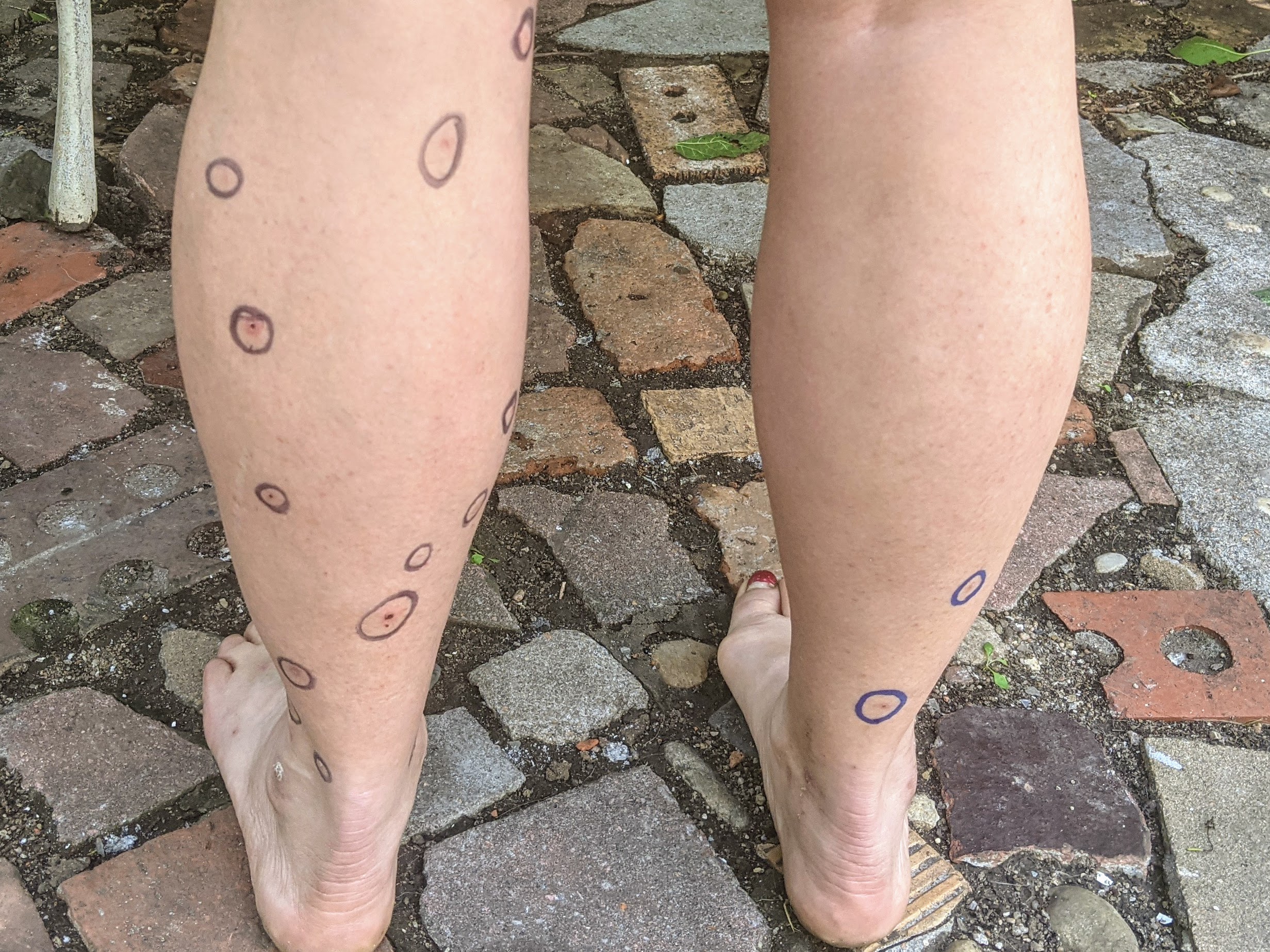 Photo of back of legs with mosquito bites circled