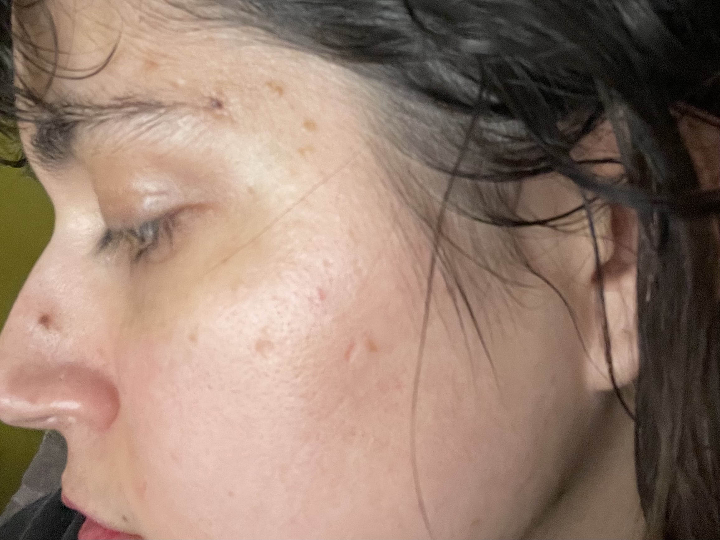 Before image of using Pai Rosehip Oil