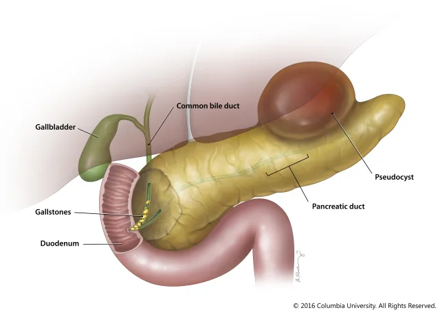 Full color illustration of acute pancreatitis and surrounding anatomy for the Pancreas Center at Columbia University Medical Center. Created as an employee of the Columbia University Medical Center Department of Surgery. Image used with permission from Columbia University. 