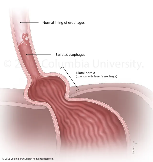 Illustration of Barrett's esophagus and hiatal hernia. Created as an employee of the Columbia University Medical Center Department of Surgery. Image used with permission from Columbia University. 