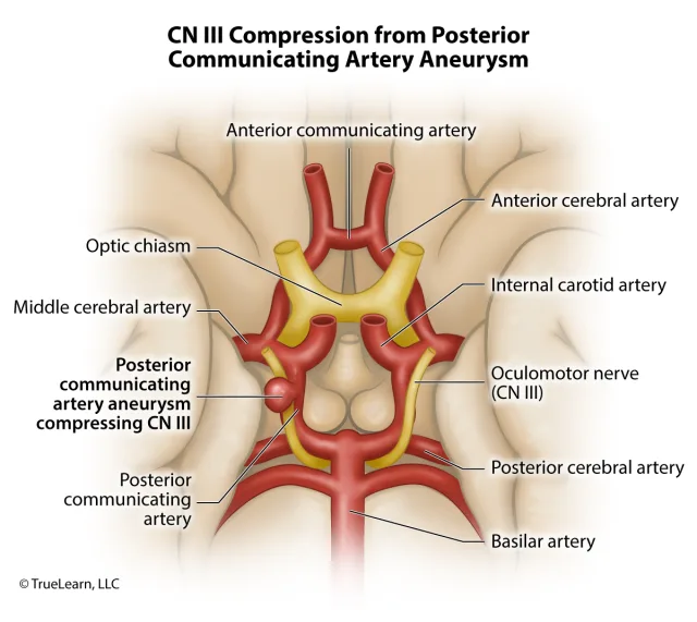 Illustration showing how aneurysms in the posterior communicating artery or posterior cerebral artery can actively compress the oculomotor nerve. Created as an employee of TrueLearn, LLC. Image used with permission. 