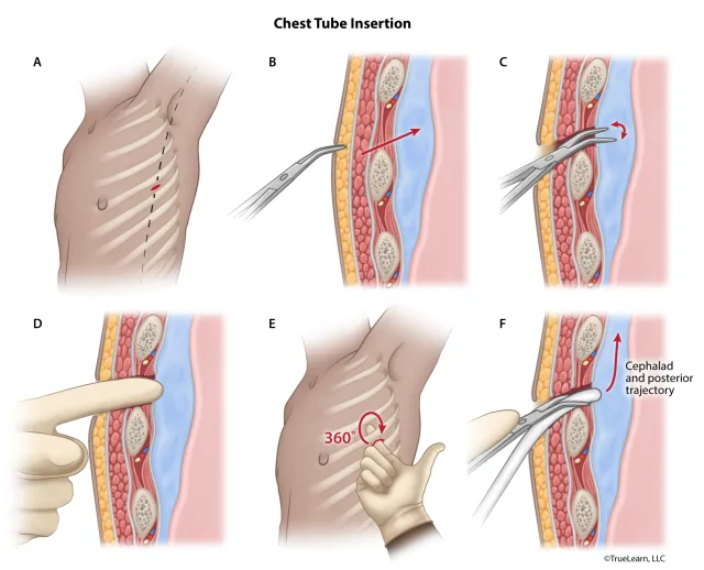 Illustration of the steps involved in chest tube insertion. Created as an employee of TrueLearn, LLC. Image used with permission. 