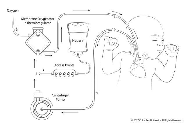 Simple diagram of pediatric ECMO circuit created for William Middlesworth, MD at Columbia University Medical Center. Created as an employee of the Columbia University Medical Center Department of Surgery. Image used with permission from Columbia University. 