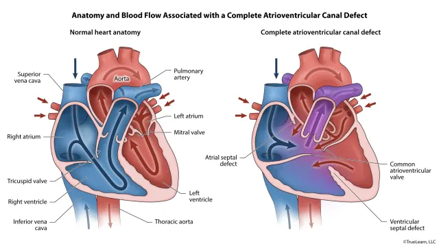 Illustration comparing the blow flood and anatomy seen in a complete atrioventricular canal defect with a normal heart. Created as an employee of TrueLearn, LLC. Image used with permission. 